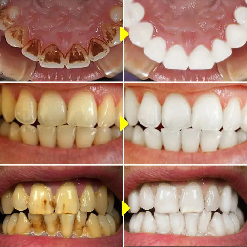 Teeth Cleansing Whitening Toothpaste Whiten Gel Whitener Bleach Removes Stains - Suncollections